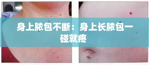 身上脓包不断：身上长脓包一碰就疼 