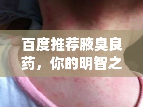 百度推荐腋臭良药，你的明智之选！